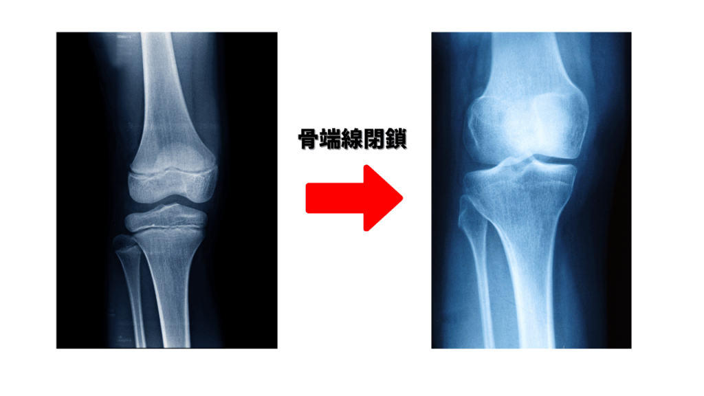 骨端線閉鎖の様子