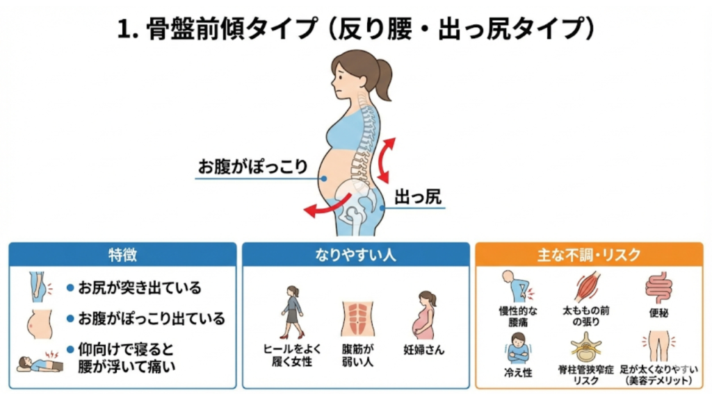 骨盤前傾タイプの特徴と症状を表したイラスト