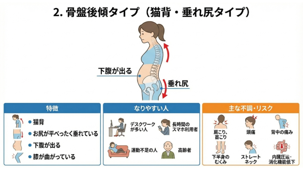 骨盤後傾タイプの特徴と症状を表したイラスト